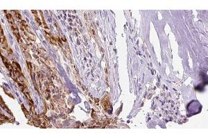 ABIN6267132 at 1/100 staining Human thyroid cancer tissue by IHC-P. (KSR1 anticorps  (pSer40, pSer392))