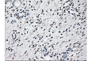 Immunohistochemical staining of paraffin-embedded Adenocarcinoma of breast tissue using anti-BRAF mouse monoclonal antibody. (BRAF anticorps)