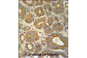 CRABP1 Antibody (C-term) (ABIN651614 and ABIN2840325) immunohistochemistry analysis in formalin fixed and paraffin embedded human prostate carcinoma followed by peroxidase conjugation of the secondary antibody and DAB staining. (CRABP1 anticorps  (C-Term))