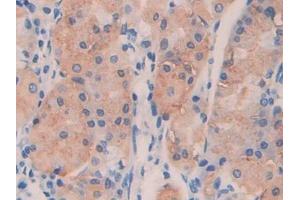 IHC-P analysis of Human Stomach cancer Tissue, with DAB staining. (ANGPTL4 anticorps  (AA 182-388))