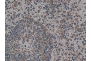 IHC-P analysis of Human Skin cancer Tissue, with DAB staining. (GLG1 anticorps  (AA 1048-1145))
