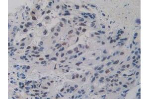 IHC-P analysis of Human Breast Cancer Tissue, with DAB staining. (Nucleolin anticorps  (AA 388-569))