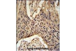 LR4 Antibody (C-term) (ABIN651164 and ABIN2840106) immunohistochemistry analysis in formalin fixed and paraffin embedded human lung carcinoma followed by peroxidase conjugation of the secondary antibody and DAB staining. (LPPR4 anticorps  (C-Term))