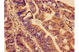 Immunohistochemistry analysis of human colon cancer using ABIN7170866 at dilution of 1:100