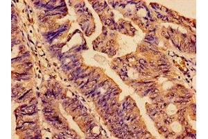 Immunohistochemistry analysis of human colon cancer using ABIN7170866 at dilution of 1:100 (SMC4 anticorps  (AA 406-501))