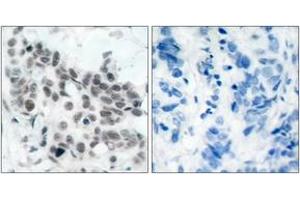 Immunohistochemistry analysis of paraffin-embedded human breast carcinoma, using Retinoblastoma (Phospho-Ser780) Antibody. (Retinoblastoma Protein (Rb) anticorps  (pSer780))