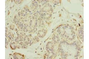 Immunohistochemistry of paraffin-embedded human breast cancer using ABIN7151184 at dilution of 1:100