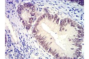 Immunohistochemical analysis of paraffin-embedded rectum cancer tissues using SATB2 mouse mAb with DAB staining. (SATB2 anticorps  (AA 377-499))