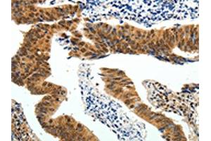 The image on the left is immunohistochemistry of paraffin-embedded Human colon cancer tissue using ABIN7130641(PIWIL4 Antibody) at dilution 1/25, on the right is treated with fusion protein. (PIWIL4 anticorps)