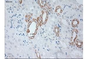 Immunohistochemical staining of paraffin-embedded Carcinoma of kidney tissue using anti-KRT19mouse monoclonal antibody. (Cytokeratin 19 anticorps  (AA 240-390))