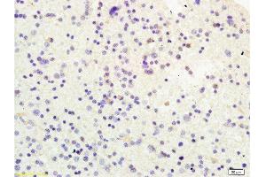 Formalin-fixed and human glioma tissue labeled with Anti-USP-1 Polyclonal Antibody, Unconjugated  at 1:200 followed by conjugation to the secondary antibody and DAB staining (USP1 anticorps  (AA 701-785))