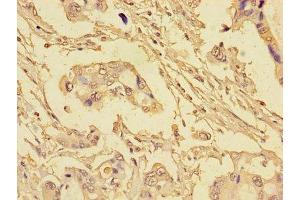 Immunohistochemistry of paraffin-embedded human pancreatic cancer using ABIN7152193 at dilution of 1:100 (eIF4EBP1 anticorps  (AA 2-111))