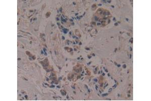 IHC-P analysis of Human Breast Cancer Tissue, with DAB staining. (APOA1BP anticorps  (AA 118-282))