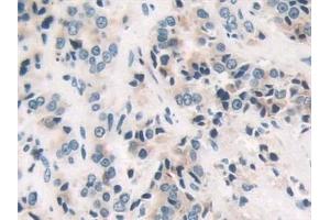 Detection of PAR4 in Human Prostate cancer Tissue using Polyclonal Antibody to Protease Activated Receptor 4 (PAR4)