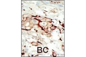 Formalin-fixed and paraffin-embedded human cancer tissue reacted with the primary antibody, which was peroxidase-conjugated to the secondary antibody, followed by AEC staining.