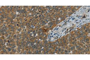 Immunohistochemistry of paraffin-embedded Human cervical cancer using E2F6 Polyclonal Antibody at dilution of 1:60