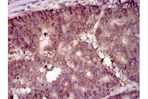 Immunohistochemical analysis of paraffin-embedded colon cancer tissues using EIF4B mouse mAb with DAB staining. (EIF4B anticorps)
