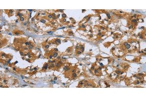 Immunohistochemistry of paraffin-embedded Human thyroid cancer using RAP1B Polyclonal Antibody at dilution of 1:50 (RAP1B anticorps)