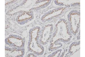 IHC-P Image Immunohistochemical analysis of paraffin-embedded human endometrial cancer, using YIPF4, antibody at 1:500 dilution. (YIPF4 anticorps)