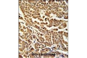 ZN Antibody (C-term) (ABIN651881 and ABIN2840437) immunohistochemistry analysis in formalin fixed and paraffin embedded human skin carcinoma followed by peroxidase conjugation of the secondary antibody and DAB staining. (RNF114 anticorps  (C-Term))