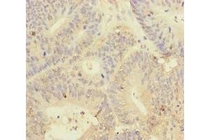 Immunohistochemistry of paraffin-embedded human colon cancer using ABIN7145011 at dilution of 1:100 (YME1L1 anticorps  (AA 1-240))