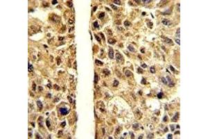 IHC analysis of FFPE human hepatocarcinoma stained with ARG1 antibody (Liver Arginase anticorps  (AA 293-322))