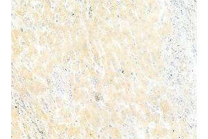 ABIN6264572 and ABIN6279737 at 1/100 staining human hepatocellular carcinoma by IHC-P.