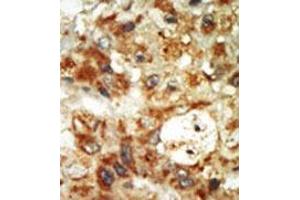 Formalin-fixed and paraffin-embedded human cancer tissue (hepatocarcinoma) reacted with the primary antibody, which was peroxidase-conjugated to the secondary antibody, followed by AEC staining. (MAPK12 anticorps  (Middle Region))