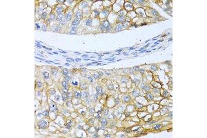 Immunohistochemistry of paraffin-embedded human prostate cancer using BMP4 antibody at dilution of 1:100 (40x lens). (BMP4 anticorps)