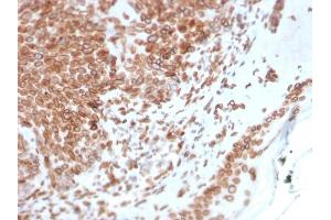 Formalin-fixed, paraffin-embedded human Basal Cell Carcinoma stained with Emerin Mouse Monoclonal Antibody (EMD/2168).