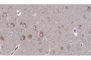 ABIN6276758 at 1/100 staining Human brain cancer tissue by IHC-P.