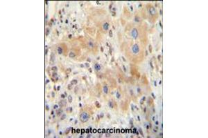 NR0B2 antibody immunohistochemistry analysis in formalin fixed and paraffin embedded human hepatocarcinoma followed by peroxidase conjugation of the secondary antibody and DAB staining. (NR0B2 anticorps  (AA 56-83))