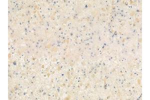 ABIN6259441 and ABIN6276271 at 1/100 staining human astrocytoma by IHC-P.