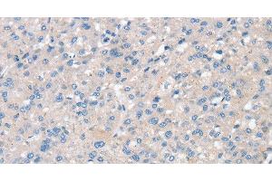 Immunohistochemistry of paraffin-embedded Human liver cancer using SNX3 Polyclonal Antibody at dilution of 1:30