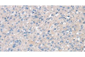 Immunohistochemistry of paraffin-embedded Human liver cancer using SNX3 Polyclonal Antibody at dilution of 1:30 (Sorting Nexin 3 anticorps)