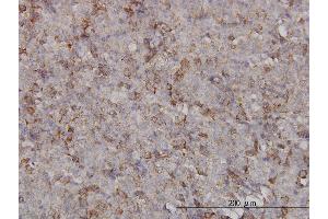 Immunoperoxidase of monoclonal antibody to KIF2C on formalin-fixed paraffin-embedded human malignant lymphoma, diffuse large B.