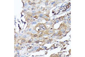 Immunohistochemistry of paraffin-embedded human lung cancer using MLST8 Rabbit pAb (ABIN6131371, ABIN6143894, ABIN6143895 and ABIN6217660) at dilution of 1:100 (40x lens). (GBL anticorps  (AA 1-326))