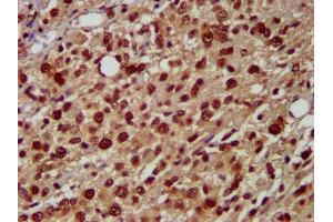IHC image of ABIN7155093 diluted at 1:500 and staining in paraffin-embedded human glioma performed on a Leica BondTM system. (HNRNPAB anticorps  (AA 1-68))