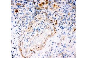 IHC-P: IP3R antibody testing of human lung cancer tissue (ITPR3 anticorps  (AA 2411-2758))