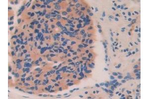 Detection of HEXb in Human Prostate cancer Tissue using Polyclonal Antibody to Hexosaminidase B Beta (HEXb) (HEXB anticorps  (AA 122-311))