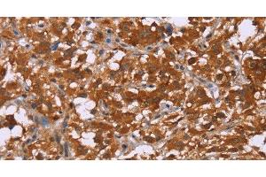 Immunohistochemistry of paraffin-embedded Human thyroid cancer tissue using DCBLD2 Polyclonal Antibody at dilution 1:50 (DCBLD2 anticorps)