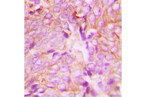 Immunohistochemical analysis of PKC delta (pY313) staining in human breast cancer formalin fixed paraffin embedded tissue section. (PKC delta anticorps  (pTyr313))