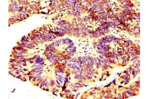 IHC image of ABIN7168252 diluted at 1:300 and staining in paraffin-embedded human ovarian cancer performed on a Leica BondTM system. (RNF219 anticorps  (AA 257-465))