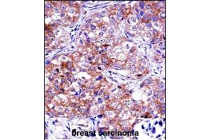 IDH1 Antibody (C-term) ((ABIN657472 and ABIN2846500))immunohistochemistry analysis in formalin fixed and paraffin embedded human breast carcinoma followed by peroxidase conjugation of the secondary antibody and DAB staining.