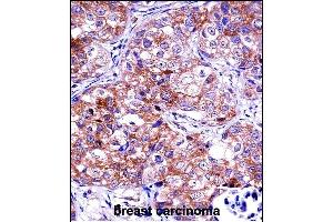 IDH1 Antibody (C-term) ((ABIN657472 and ABIN2846500))immunohistochemistry analysis in formalin fixed and paraffin embedded human breast carcinoma followed by peroxidase conjugation of the secondary antibody and DAB staining. (IMPDH1 anticorps  (C-Term))