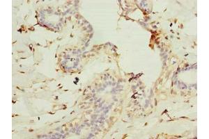 Immunohistochemistry of paraffin-embedded human breast cancer using ABIN7147425 at dilution of 1:100 (Cep76 anticorps  (AA 241-550))