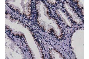 Immunohistochemical staining of paraffin-embedded Carcinoma of Human kidney tissue using anti-NT5DC1 mouse monoclonal antibody. (NT5DC1 anticorps)