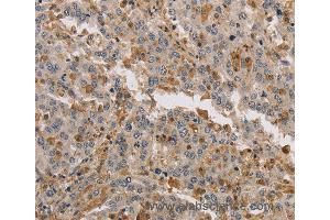 Immunohistochemistry of Human liver cancer using KIF17 Polyclonal Antibody at dilution of 1:40 (KIF17 anticorps)