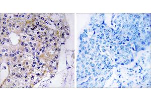 Peptide - +Immunohistochemistry analysis of paraffin-embedded human breast carcinoma tissue using CEP110 antibody. (Centriolin anticorps)