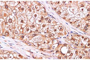 Immunohistochemistry of paraffin-embedded Human liver cancer using CDK4 Polyclonal Antibody at dilution of 1:100 (CDK4 anticorps)